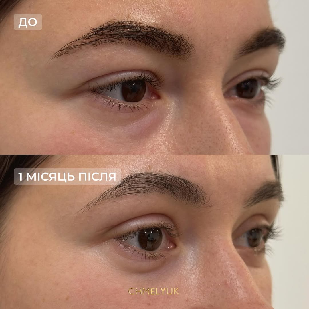Блефаропластика