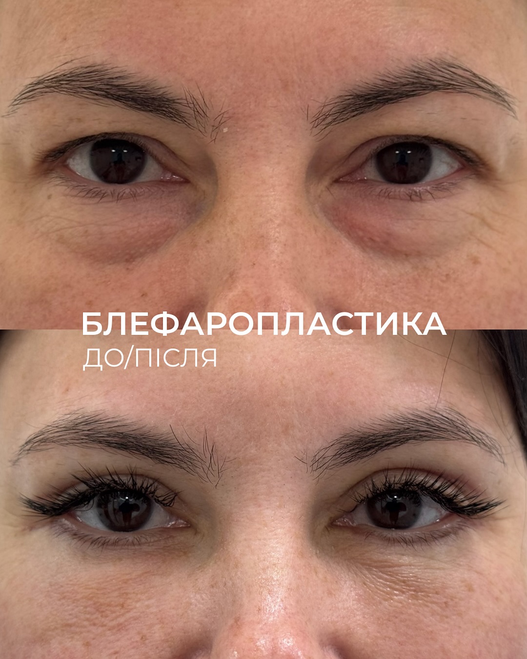 Блефаропластика