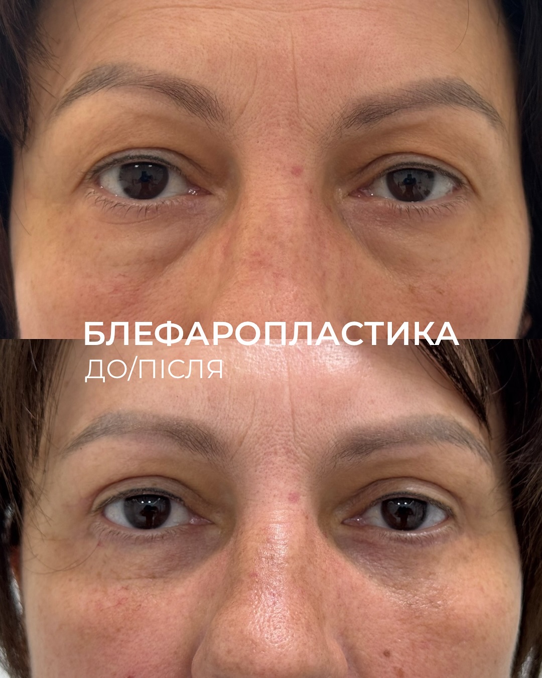 Блефаропластика